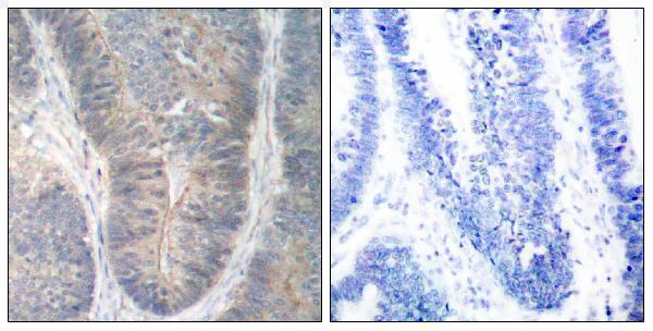 Immunohistochemistry analysis of paraffin-embedded human colon carcinoma, using PKR (Phospho-Thr451) Antibody