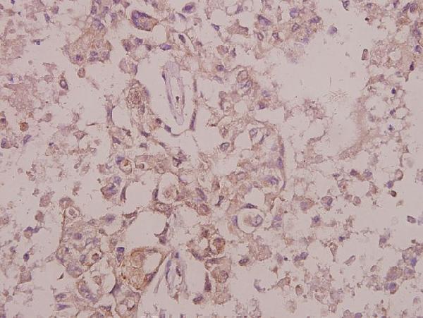 Immunohistochemistry (IHC) analyzes of p-Trk B (Y515) pAb in paraffin-embedded human colorectal carcinoma tissue at 1:50