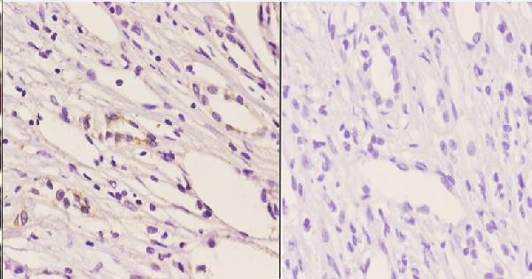 Immunohistochemistry (IHC) analyzes of p-Trk B (Y706) pAb in paraffin-embedded human kidney carcinoma tissue at 1:50