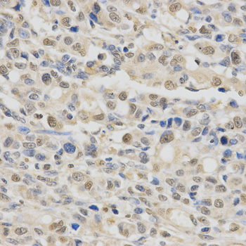 Immunohistochemistry (IHC) analysis of SPHK1 pAb in paraffin-embedded Human Stomach Cancer tissue