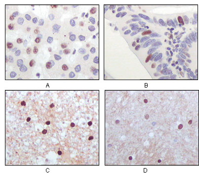 Immunohistochemistry analysis of paraffin-embedded human liver carcinoma (A), recturn carcinoma (B), normal medulla tissue (C) and normal interbrain tissues (D), showing nuclear localization with DAB staining using TIP60 Monoclonal Antibody