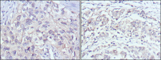 Immunohistochemistry analysis of paraffin-embedded human lung cancer (left) and gastric cancer (right) with DAB staining using PAKγ Monoclonal Antibody