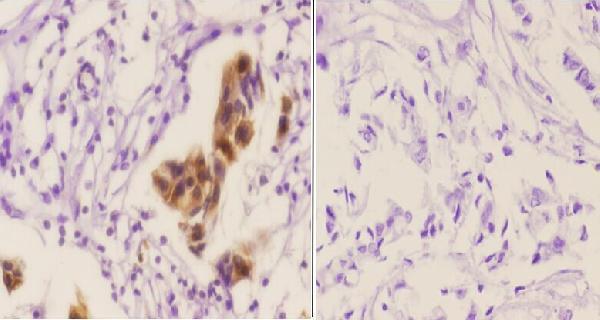Immunohistochemistry (IHC) analyzes of p-PAK2 (S20) pAb in paraffin-embedded human breast carcinoma tissue at 1:50