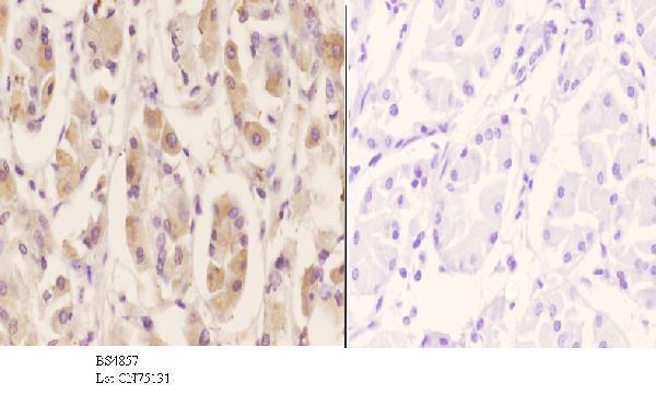 Immunohistochemistry (IHC) analyzes of p-PAK2 (S20) pAb in paraffin-embedded human stomach carcinoma tissue at 1:50