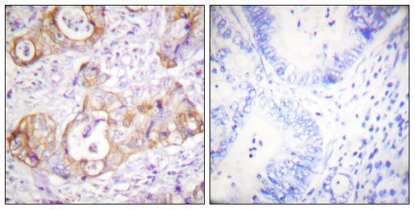Immunohistochemistry analysis of paraffin-embedded human colon carcinoma, using Keratin 8 (Phospho-Ser432) Antibody