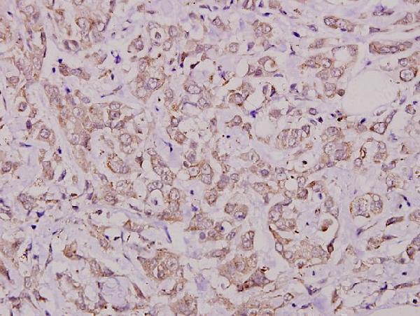 Immunohistochemistry (IHC) analyzes of p-Cdc25A (S76) pAb in paraffin-embedded human breast carcinoma tissue at 1:100