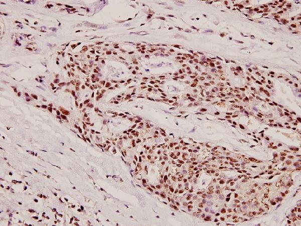 Immunohistochemistry (IHC) analyzes of Fes (K161) pAb in paraffin-embedded human breast carcinoma tissue at 1:100