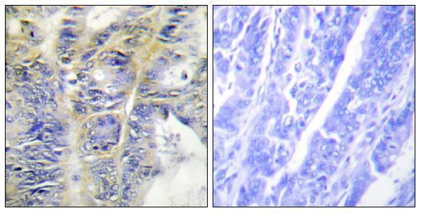 Immunohistochemistry analysis of paraffin-embedded human colon carcinoma tissue, using Collagen IV alpha5 Antibody
