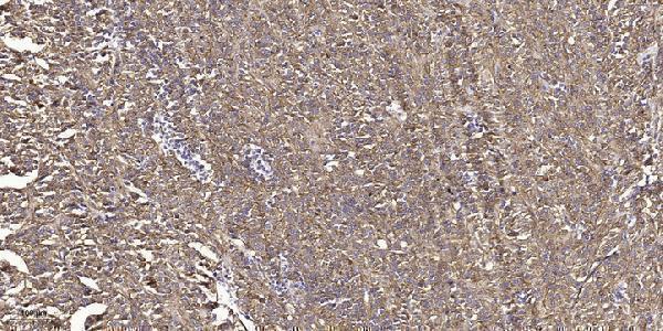 Immunohistochemical analysis of paraffin-embedded human small intestinal carcinoma tissue
