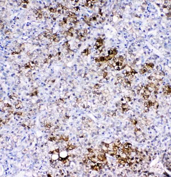 IHC analysis of GSTA1/A2/A3/A4/A5 using anti-GSTA1/A2/A3/A4/A5 antibody (A01462-1). GSTA1/A2/A3/A4/A5 was detected in paraffin-embedded section of human liver cancer tissues. Heat mediated antigen retrieval was performed in citrate buffer (pH6, epitope retrieval solution) for 20 mins. The tissue section was blocked with 10% goat serum. The tissue section was then incubated with 1μg/ml rabbit anti-GSTA1/A2/A3/A4/A5 Antibody (A01462-1) overnight at 4°C. Biotinylated goat anti-rabbit IgG was used as secondary antibody and incubated for 30 minutes at 37°C. The tissue section was developed using Strepavidin-Biotin-Complex (SABC)(Catalog # SA1022) with DAB as the chromogen.