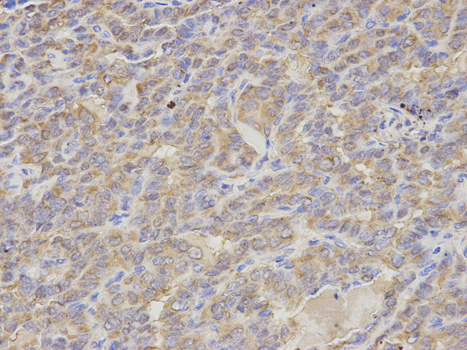 Immunohistochemistry of paraffin-embedded human colon carcinoma using S100A12 Rabbit pAb  at dilution of 1:350 