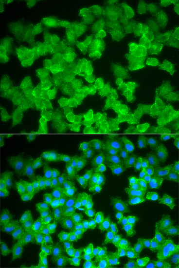 Immunohistochemistry of paraffin-embedded human esophageal cancer using S100A12 Rabbit pAb  at dilution of 1:350 
