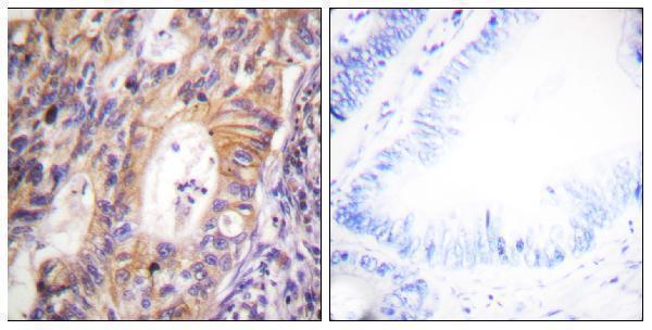 Immunohistochemistry analysis of paraffin-embedded human colon carcinoma, using c-Met (Phospho-Tyr1003) Antibody