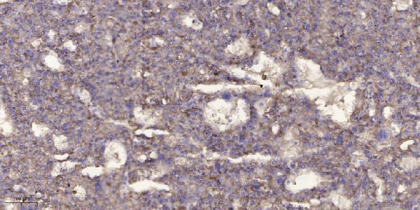 Immunohistochemical analysis of paraffin-embedded human liver cancer