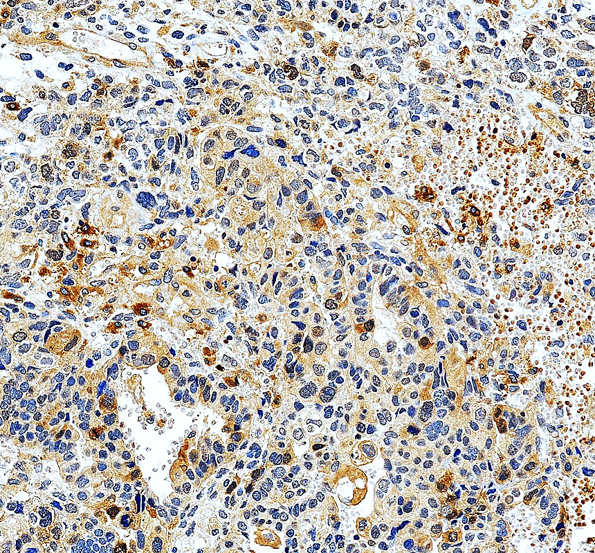 IHC analysis of UBE2C using anti-UBE2C antibody (A01491-1)