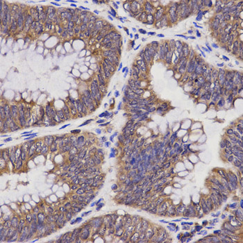 Immunohistochemistry of paraffin-embedded human colon carcinoma using TAP2 Rabbit pAb  at dilution of 1:100 
