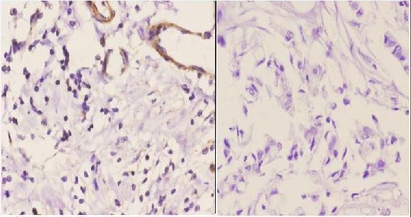Immunohistochemistry (IHC) analyzes of EDG-1 (T48) pAb in paraffin-embedded human breast carcinoma tissue at 1:50