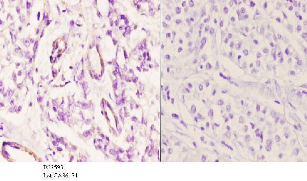 Immunohistochemistry (IHC) analyzes of EDG-1 (T48) pAb in paraffin-embedded human liver carcinoma tissue at 1:50
