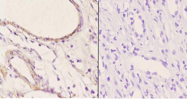 Immunohistochemistry (IHC) analyzes of EDG-1 (T48) pAb in paraffin-embedded human kidney carcinoma tissue at 1:50