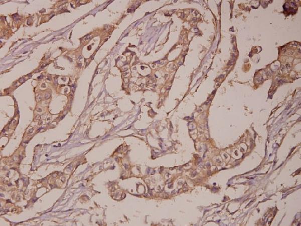 Immunohistochemistry (IHC) analyzes of PSA (L106) pAb in paraffin-embedded human breast carcinoma tissue at 1:50