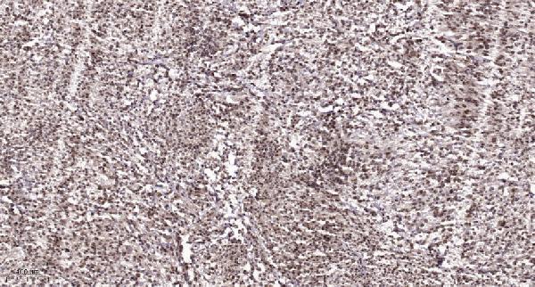 Immunohistochemical analysis of paraffin-embedded human Colon cancer