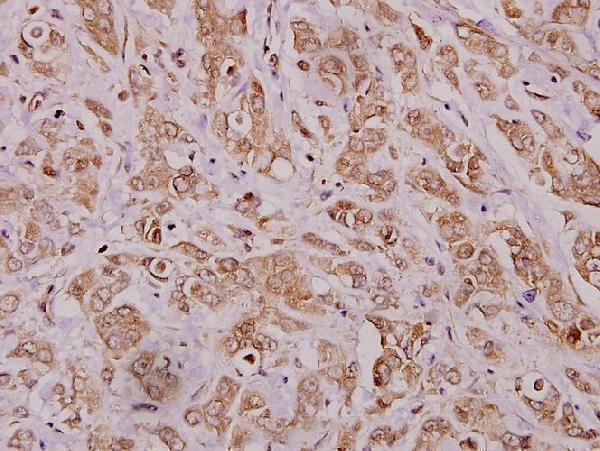 Immunohistochemistry (IHC) analyzes of MMP-12 (D411) pAb in paraffin-embedded human breast carcinoma tissue at 1:100