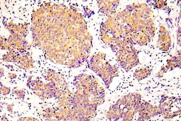 Immunohistochemistry (IHC) analyzes of p-COFILN1 (S3) pAb in paraffin-embedded human lung adenocarcinoma tissue