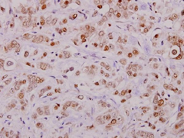 Immunohistochemistry (IHC) analyzes of p-Cofilin (S3) pAb in paraffin-embedded human breast carcinoma tissue at 1:100