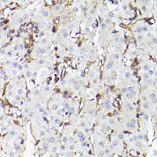 Immunohistochemistry analysis of paraffin-embedded human liver cancer using TLR8 pAb at dilution of 1:100 (40x lens)