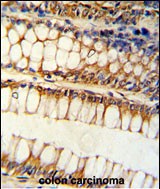 Formalin-fixed and paraffin-embedded human colon carcinoma reacted with BCL2L11 Antibody (Center), which was peroxidase-conjugated to the secondary antibody, followed by DAB staining