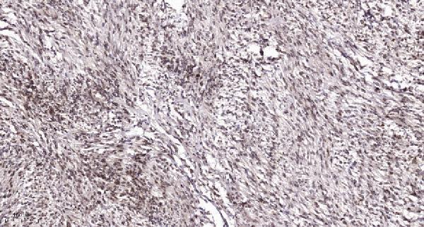 Immunohistochemical analysis of paraffin-embedded human Colon cancer