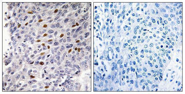 Immunohistochemistry analysis of paraffin-embedded human lung carcinoma tissue, using ATF1 Antibody