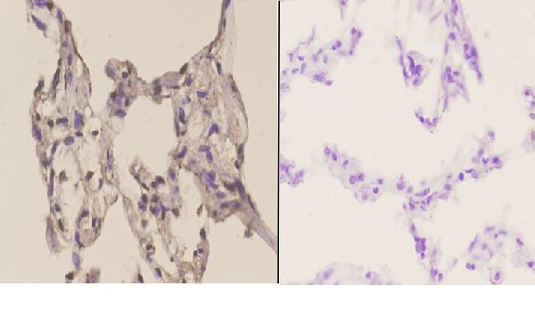 Immunohistochemistry (IHC) analyzes of ATF1 (T209) pAb in paraffin-embedded human lung carcinoma tissue at 1:50