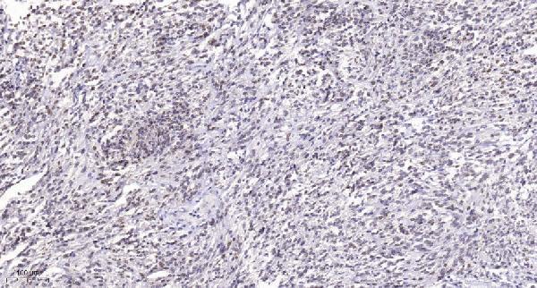 Immunohistochemical analysis of paraffin-embedded human Small intestinal stromal tumor