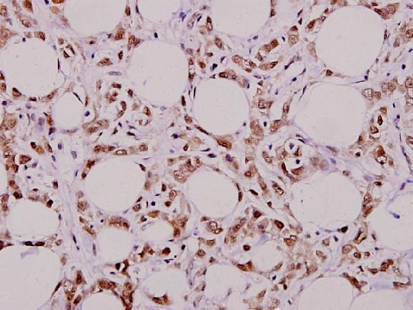 Immunohistochemistry (IHC) analyzes of MYH (Y176) pAb in paraffin-embedded human breast carcinoma tissue at 1:50
