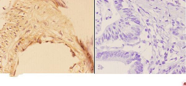 Immunohistochemistry (IHC) analyzes of AKR1B1 (K275) pAb in paraffin-embedded human colon carcinoma tissue at 1:50,showing screated staining