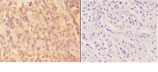 Immunohistochemistry (IHC) analyzes of AKR1B1 (K275) pAb in paraffin-embedded human liver carcinoma tissue at 1:50,showing screated staining