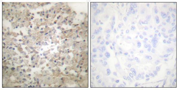 Immunohistochemistry analysis of paraffin-embedded human lung carcinoma, using Tryptophan Hydroxylase (Phospho-Ser260) Antibody