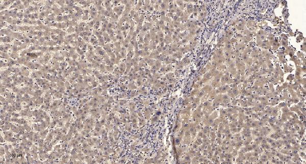 Immunohistochemical analysis of paraffin-embedded human liver cancer
