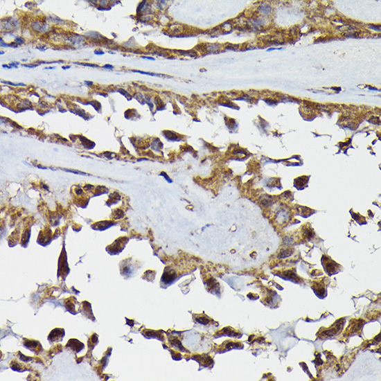 Immunohistochemistry of paraffin-embedded human thyroid cancer using TARBP2 Rabbit pAb  at dilution of 1:200 