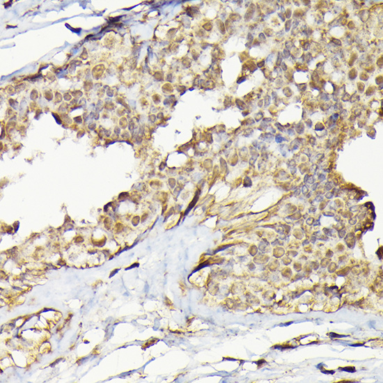 Immunohistochemistry of paraffin-embedded human breast cancer using TARBP2 Rabbit pAb  at dilution of 1:200 