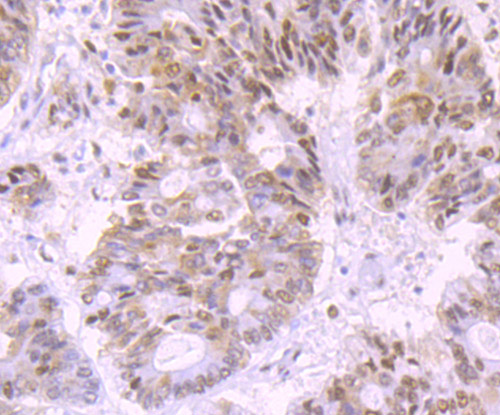 Immunohistochemical analysis of paraffin-embedded human colon cancer tissue using anti-DNA Ligase IV antibody