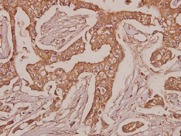 Immunohistochemistry (IHC) analyzes of Laminin-R (Q215) pAb in paraffin-embedded human breast carcinoma tissue at 1:50