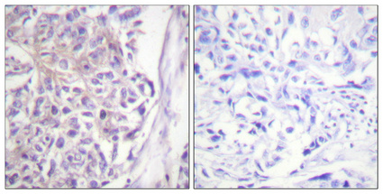 Immunohistochemical analysis of paraffin-embedded Human breast cancer