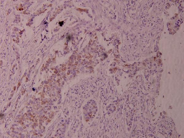 Immunohistochemistry (IHC) analyzes of p-Cot (T290) pAb in paraffin-embedded human breast carcinoma tissue at 1:100