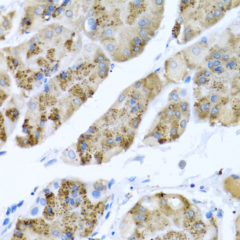 Immunohistochemistry of paraffin-embedded human breast cancer using MGP Rabbit pAb  at dilution of 1:100 