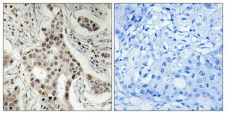 Immunohistochemistry analysis of paraffin-embedded human breast carcinoma, using NCoA2 (Phospho-Ser736) Antibody