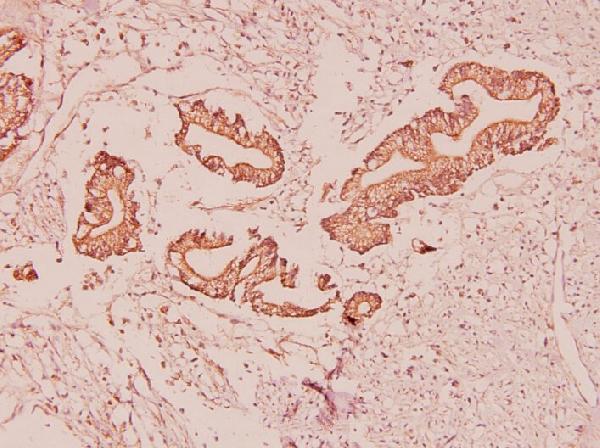 Immunohistochemistry (IHC) analyzes of Ghrelin (K47) pAb in paraffin-embedded human colorectal cancer carcinoma tissue at 1:100
