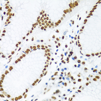 Immunohistochemistry of paraffin-embedded human prostate cancer using KHDRBS1/Sam68 antibody  at dilution of 1:100 