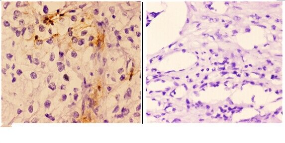 Immunohistochemistry (IHC) analyzes of Troponin I3 (G136) pAb in paraffin-embedded human kidney carcinoma tissue at 1:50,showing cytoplasmic and membrane staining